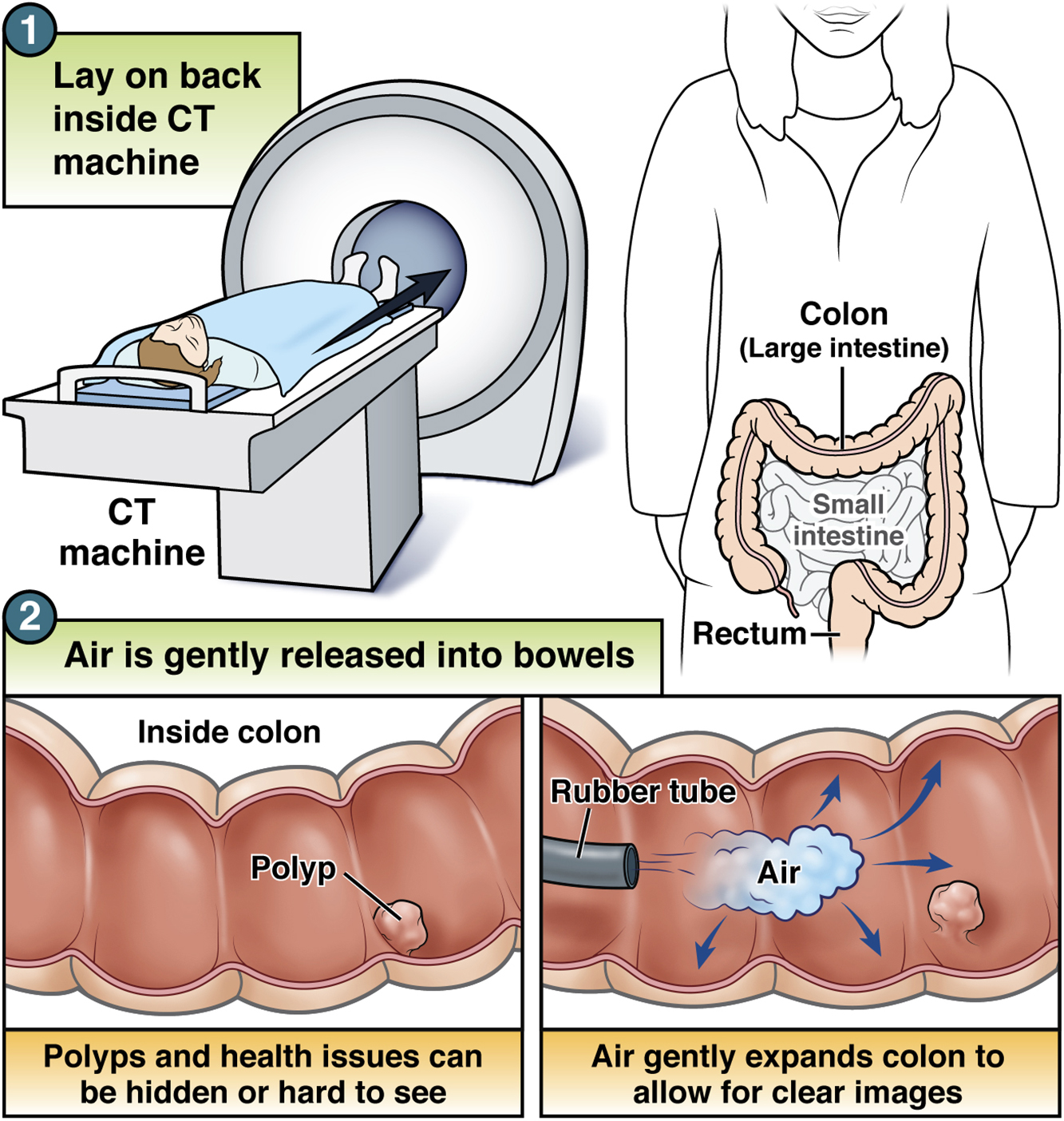 CGH PatientEd CT colonography