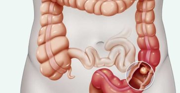 Early Warning Signs of Colon Cancer
