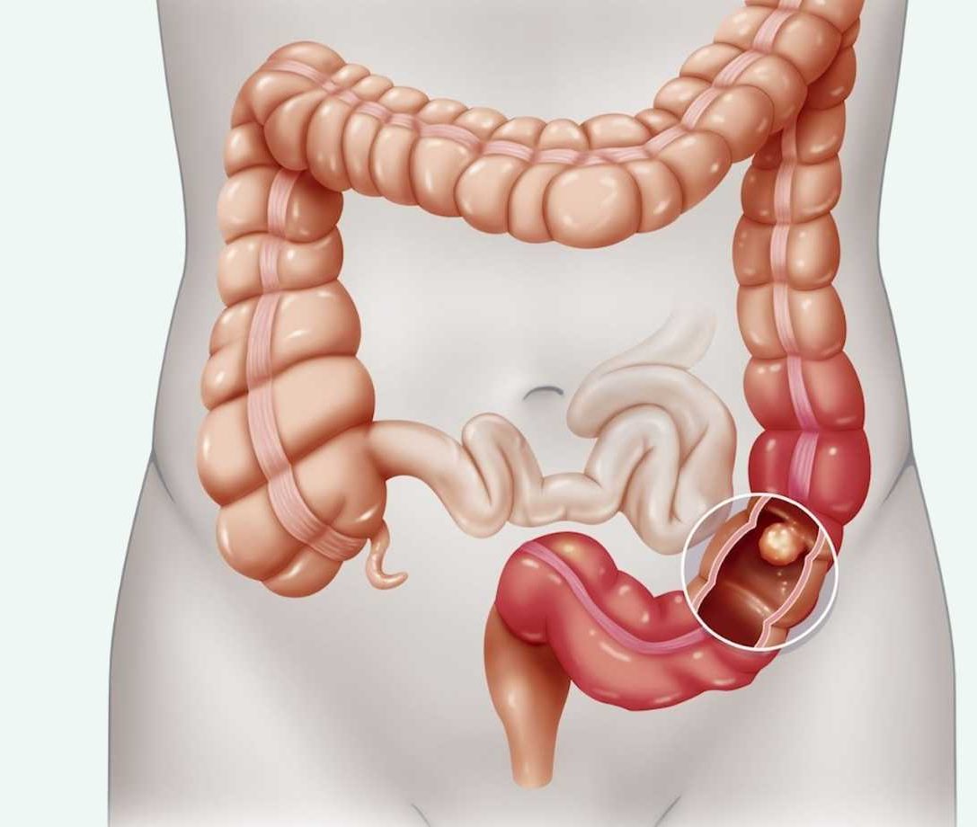Early Warning Signs of Colon Cancer